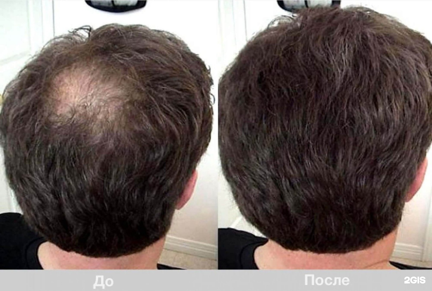мезотерапия кожи головы фото до и после